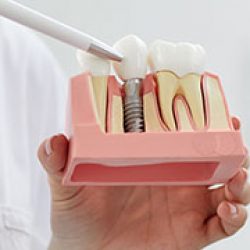 tit-especialidades-estetica-implantologia